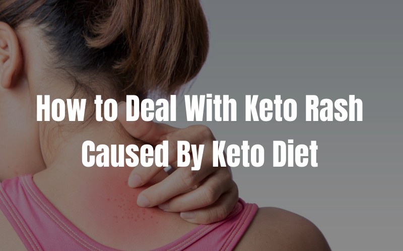 How to Deal with Keto Rash Caused by Keto Diet