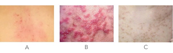 what is keto rash