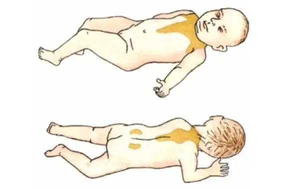 Babies are born with large amounts of brown adipose behind their shoulder blades