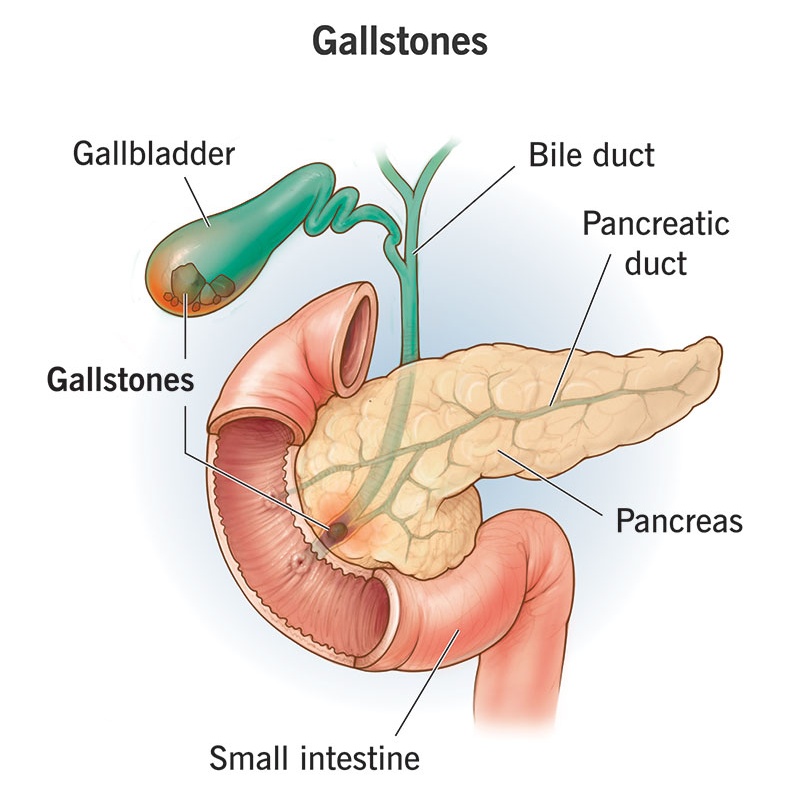 How Do Gallstones Form