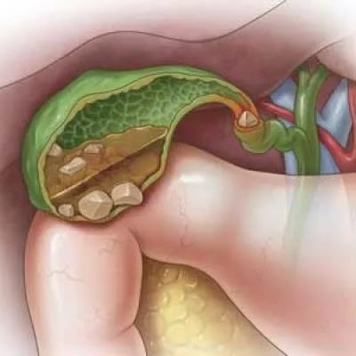 Low-fat diets, the main cause of gallstones