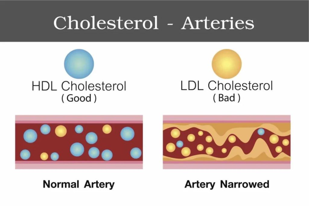 Low-carb diet to improve lipid profile