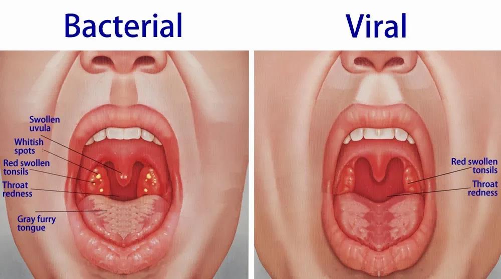 Viral Infections